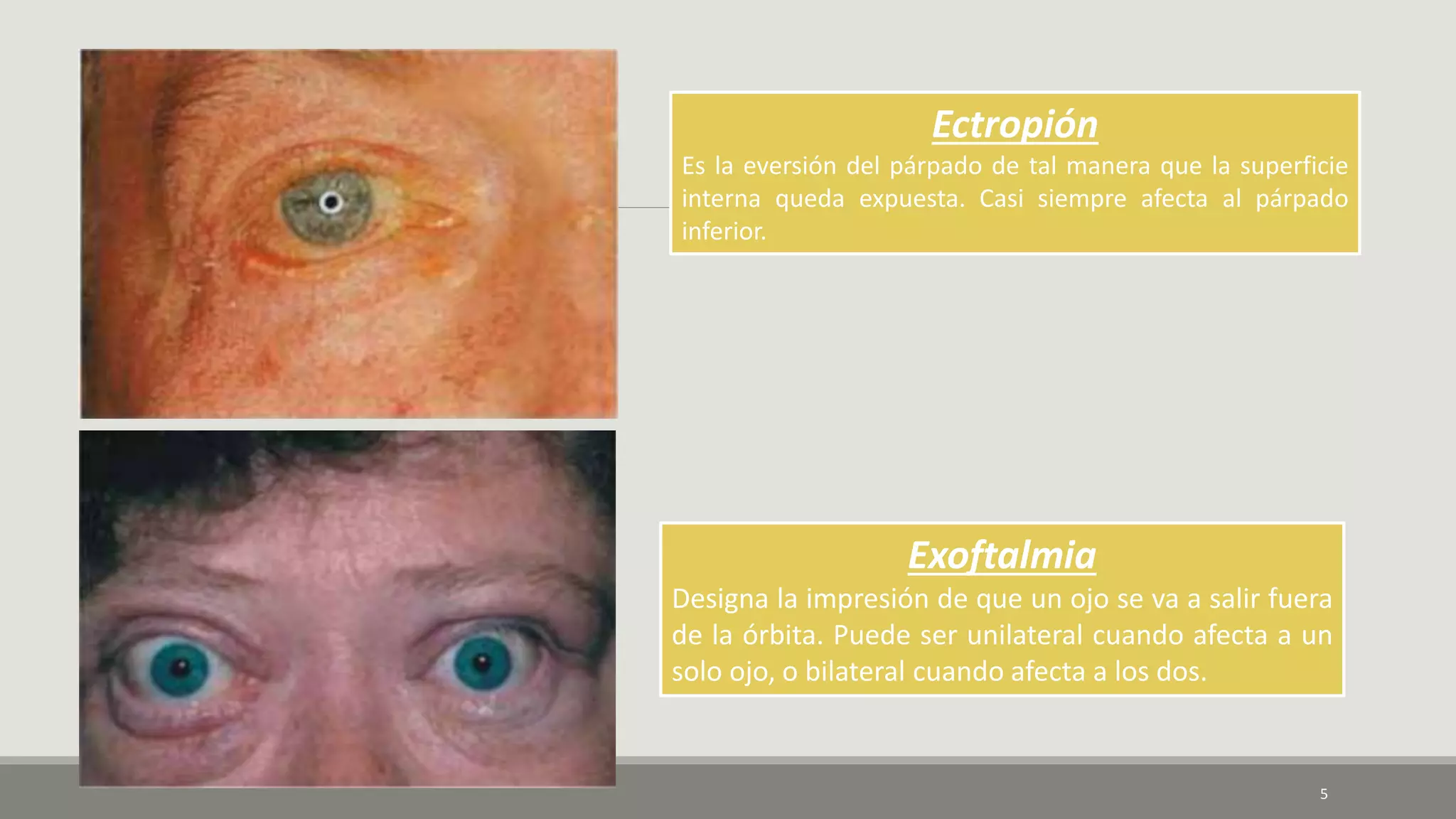 Ectropión
Es la eversión del párpado de tal manera que la superficie
interna queda expuesta. Casi siempre afecta al párpado
inferior.
Exoftalmia
Designa la impresión de que un ojo se va a salir fuera
de la órbita. Puede ser unilateral cuando afecta a un
solo ojo, o bilateral cuando afecta a los dos.
5
 