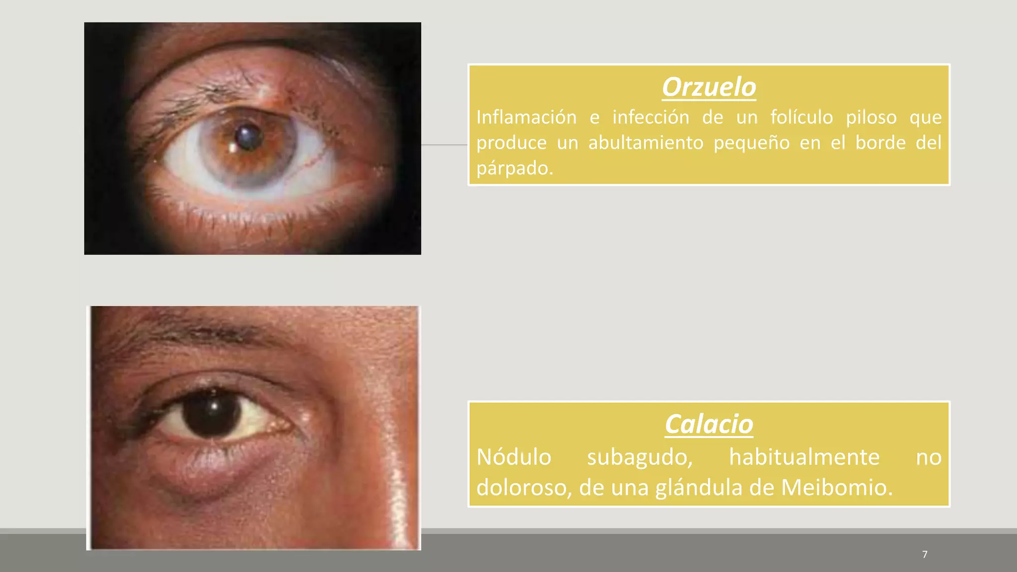 Orzuelo
Inflamación e infección de un folículo piloso que
produce un abultamiento pequeño en el borde del
párpado.
Calacio
Nódulo subagudo, habitualmente no
doloroso, de una glándula de Meibomio.
7
 