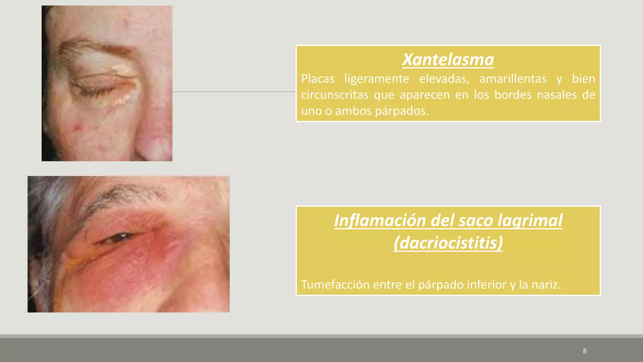 Inflamación del saco lagrimal
(dacriocistitis)
Tumefacción entre el párpado inferior y la nariz.
Xantelasma
Placas ligeramente elevadas, amarillentas y bien
circunscritas que aparecen en los bordes nasales de
uno o ambos párpados.
8
 