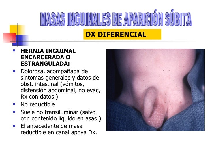 Hernia Inguinal Sintomas De Una De Las Hernias Mas Frecuentes
