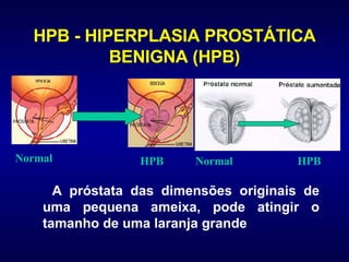 HPB - HIPERPLASIA PROSTÁTICA BENIGNA (HPB) A próstata das dimensões originais de uma pequena ameixa, pode atingir o tamanho de uma laranja grande Normal HPB Normal HPB 