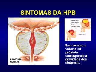 SINTOMAS DA HPB Nem sempre o volume da próstata corresponde à gravidade dos sintomas.  