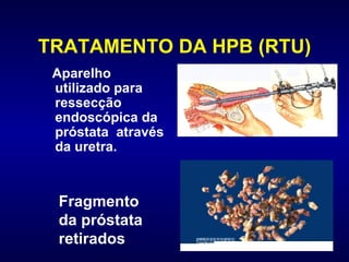 TRATAMENTO DA HPB (RTU) Aparelho utilizado para ressecção endoscópica da próstata  através da uretra.  Fragmento da próstata retirados . 