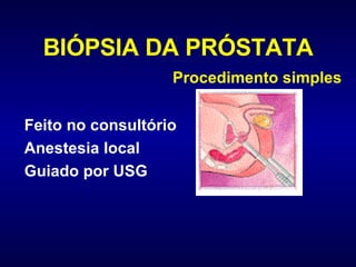 BIÓPSIA DA PRÓSTATA Feito no consultório Anestesia local Guiado por USG Procedimento simples                  