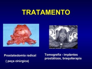 TRATAMENTO     Prostatectomia radical  ( peça cirúrgica) Tomografia - implantes prostáticos, braquiterapia                                                          