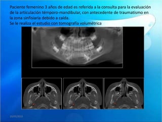 Paciente femenino 3 años de edad es referida a la consulta para la evaluación
de la articulación témporo-mandibular, con antecedente de traumatismo en
la zona sinfisiaria debido a caída.
Se le realiza el estudio con tomografía volumétrica




19/05/2010
 