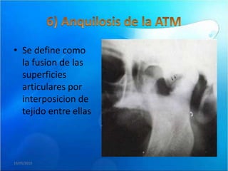 • Se define como
  la fusion de las
  superficies
  articulares por
  interposicion de
  tejido entre ellas



19/05/2010
 