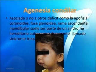 • Asociada o no a otros deficit como la apofisis
  coronoides, fosa glenoidea, rama ascendente
  mandibular suele ser parte de un sindrome
  hereditario autosomico dominante llamado
  sindrome treacher -collins




19/05/2010
 