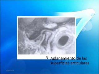 • Aplanamiento de las
               superficies articulares
19/05/2010
 