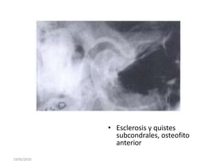 • Esclerosis y quistes
               subcondrales, osteofito
               anterior

19/05/2010
 