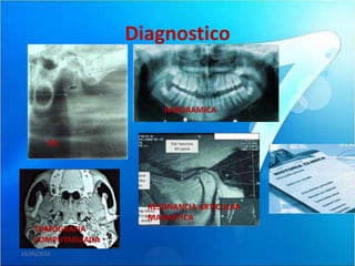 Diagnostico


                         PANORAMICA


         RX




                      RESONANCIA ARTICULAR
                      MAGNETICA
    TOMOGRAFIA
    COMPUTARIZADA
19/05/2010
 