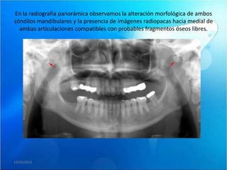 En la radiografía panorámica observamos la alteración morfológica de ambos
cóndilos mandibulares y la presencia de imágenes radiopacas hacia medial de
  ambas articulaciones compatibles con probables fragmentos óseos libres.




19/05/2010
 