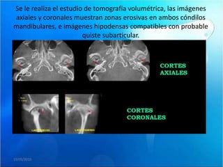 Se le realiza el estudio de tomografía volumétrica, las imágenes
axiales y coronales muestran zonas erosivas en ambos cóndilos
mandibulares, e imágenes hipodensas compatibles con probable
                        quiste subarticular.




19/05/2010
 