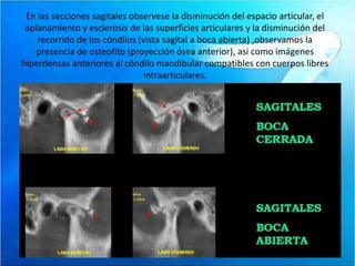 En las secciones sagitales observese la disminución del espacio articular, el
 aplanamiento y esclerosis de las superficies articulares y la disminución del
    recorrido de los cóndilos (vista sagital a boca abierta) ,observamos la
    presencia de osteofito (proyección ósea anterior), asi como imágenes
hiperdensas anteriores al cóndilo mandibular compatibles con cuerpos libres
                               intraarticulares.




19/05/2010
 