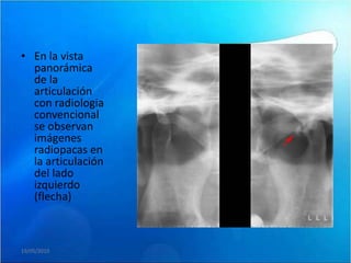 • En la vista
  panorámica
  de la
  articulación
  con radiologia
  convencional
  se observan
  imágenes
  radiopacas en
  la articulación
  del lado
  izquierdo
  (flecha)



19/05/2010
 
