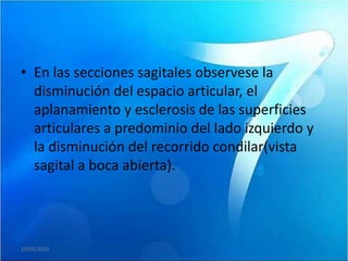 • En las secciones sagitales observese la
  disminución del espacio articular, el
  aplanamiento y esclerosis de las superficies
  articulares a predominio del lado izquierdo y
  la disminución del recorrido condilar(vista
  sagital a boca abierta).




19/05/2010
 