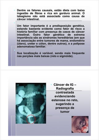 Dentre os fatores causais, estão dieta com baixaDentre os fatores causais, estão dieta com baixa
ingestão de fibras e rica em gordura animal. Oingestão de fibras e rica em gordura animal. O
tabagismo não esttabagismo não estáá associado como causa deassociado como causa de
câncer intestinal.câncer intestinal.
Um fator importanteUm fator importante éé a predisposia predisposiçção genão genéética,tica,
estando bastante evidente como fator de risco aestando bastante evidente como fator de risco a
histhistóória familiar com presenria familiar com presençça de casos de câncera de casos de câncer
intestinal. Outro fator genintestinal. Outro fator genéético de extrematico de extrema
importância são as simportância são as sííndromes hereditndromes hereditáárias (em querias (em que
hháá associaassociaçção entre tumores de mama, endomão entre tumores de mama, endoméétriotrio
((úútero), ureter e ctero), ureter e cóólon, dentre outros), e alon, dentre outros), e a poliposepolipose
adenomatosaadenomatosa familiar.familiar.
Sua localizaSua localizaççãoão éé varivariáável, sendo maisvel, sendo mais frequentefrequente
nas pornas porçções mais baixas (reto e sigmões mais baixas (reto e sigmóóide).ide).
Câncer de IGCâncer de IG ––
RadiografiaRadiografia
contrastadacontrastada
evidenciandoevidenciando
estenose no reto,estenose no reto,
sugerindo asugerindo a
presenpresençça dea de
tumortumor
 