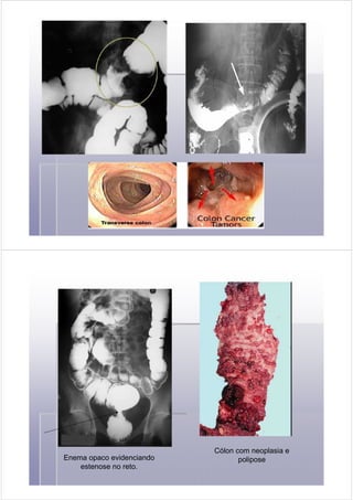 Cólon com neoplasia e
poliposeEnema opaco evidenciando
estenose no reto.
 