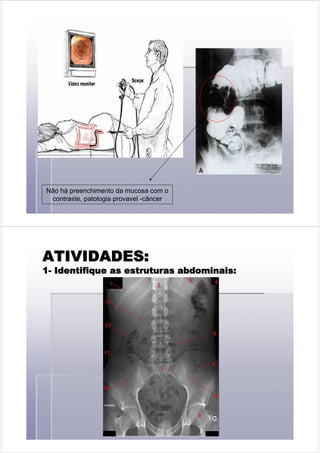 Não há preenchimento da mucosa com o
contraste, patologia provavel -câncer
ATIVIDADES:ATIVIDADES:ATIVIDADES:ATIVIDADES:ATIVIDADES:ATIVIDADES:ATIVIDADES:ATIVIDADES:
11111111-------- Identifique as estruturas abdominais:Identifique as estruturas abdominais:Identifique as estruturas abdominais:Identifique as estruturas abdominais:Identifique as estruturas abdominais:Identifique as estruturas abdominais:Identifique as estruturas abdominais:Identifique as estruturas abdominais:
 