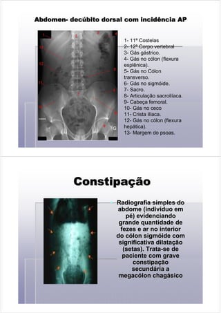 1- 11ª Costelas
2- 12ª Corpo vertebral
3- Gás gástrico.
4- Gás no cólon (flexura
esplênica).
5- Gás no Cólon
transverso.
6- Gás no sigmóide.
7- Sacro.
8- Articulação sacroilíaca.
9- Cabeça femoral.
10- Gás no ceco
11- Crista ilíaca.
12- Gás no cólon (flexura
hepática).
13- Margem do psoas.
AbdomenAbdomenAbdomenAbdomenAbdomenAbdomenAbdomenAbdomen-------- decdecdecdecdecdecdecdecúúúúúúúúbito dorsal com incidência APbito dorsal com incidência APbito dorsal com incidência APbito dorsal com incidência APbito dorsal com incidência APbito dorsal com incidência APbito dorsal com incidência APbito dorsal com incidência AP
ConstipaConstipaConstipaConstipaConstipaConstipaConstipaConstipaççççççççãoãoãoãoãoãoãoão
Radiografia simples doRadiografia simples do
abdome (indivabdome (indivííduo emduo em
ppéé) evidenciando) evidenciando
grande quantidade degrande quantidade de
fezes e ar no interiorfezes e ar no interior
do cdo cóólon sigmlon sigmóóide comide com
significativa dilatasignificativa dilataççãoão
(setas). Trata(setas). Trata--se dese de
paciente com gravepaciente com grave
constipaconstipaççãoão
secundsecundáária aria a
megacmegacóólonlon chagchagáásicosico
 