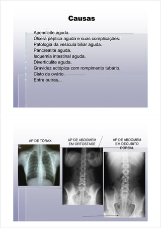 CausasCausasCausasCausasCausasCausasCausasCausas
ApendiciteApendicite aguda.aguda.
ÚÚlcera plcera péépticaptica aguda e suas complicaaguda e suas complicaçções.ões.
Patologia daPatologia da vesvesíícula biliarcula biliar aguda.aguda.
PancreatitePancreatite aguda.aguda.
IsquemiaIsquemia intestinalintestinal aguda.aguda.
DiverticuliteDiverticulite aguda.aguda.
Gravidez ectGravidez ectóópicapica com rompimento tubcom rompimento tubáário.rio.
Cisto de ovCisto de ováário.rio.
Entre outras...Entre outras...
AP DE TÓRAX AP DE ABDOMEM
EM ORTOSTASE
AP DE ABDOMEM
EM DECUBITO
DORSAL
 