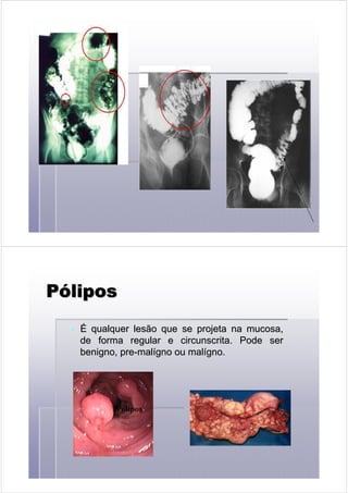 PPPPPPPPóóóóóóóóliposliposliposliposliposliposliposlipos
ÉÉ qualquer lesão que se projeta na mucosa,qualquer lesão que se projeta na mucosa,
de forma regular e circunscrita. Pode serde forma regular e circunscrita. Pode ser
benigno,benigno, prepre--malmalíígnogno ouou malmalíígnogno..
 