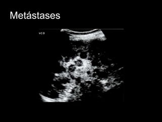 Metástases
 
