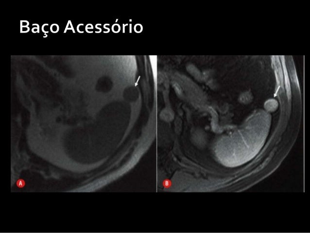 Patologias Baço