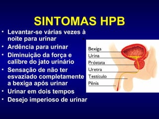 SINTOMAS HPB Levantar-se várias vezes à noite para urinar Ardência para urinar Diminuição da força e calibre do jato urinário Sensação de não ter esvaziado completamente a bexiga após urinar Urinar em dois tempos Desejo imperioso de urinar 
