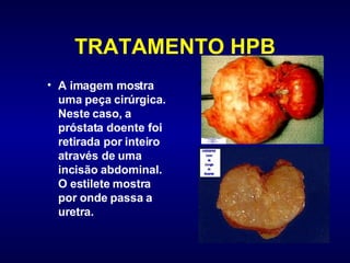 TRATAMENTO HPB A imagem mostra uma peça cirúrgica. Neste caso, a próstata doente foi retirada por inteiro através de uma incisão abdominal. O estilete mostra por onde passa a uretra. 