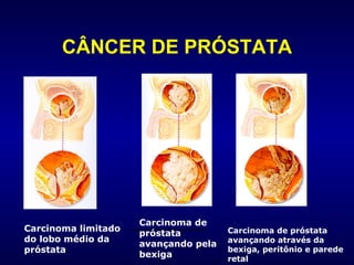 CÂNCER DE PRÓSTATA Carcinoma limitado do lobo médio da próstata Carcinoma limitado do lobo médio da próstata Carcinoma de próstata avançando pela bexiga Carcinoma de próstata avançando através da bexiga, peritônio e parede retal 