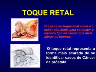 TOQUE RETAL O toque retal representa a forma mais acurada de se identificar casos de Câncer da próstata O exame do toque retal ainda é o maior obstáculo para combater o terceiro tipo de câncer que mais atinge os homens   