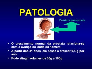 PATOLOGIA O crescimento normal da próstata relaciona-se com o avanço da idade do homem.  A partir dos 31 anos, ela passa a crescer 0,4 g por ano. Pode atingir volumes de 60g a 100g Próstata aumentada 