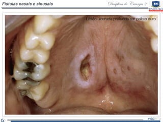 Disciplina de Cirurgia 2Fístulas nasais e sinusais
Lesão ulcerada profunda em palato duro
 