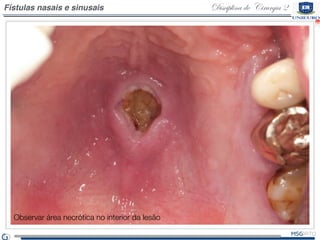 Disciplina de Cirurgia 2Fístulas nasais e sinusais
Observar área necrótica no interior da lesão
 