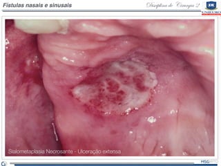 Disciplina de Cirurgia 2Fístulas nasais e sinusais
Sialometaplasia Necrosante - Ulceração extensa
 