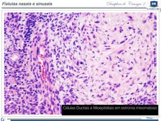 Disciplina de Cirurgia 2Fístulas nasais e sinusais
Células Ductais e Mioepiteliais em estroma mixomatoso
 