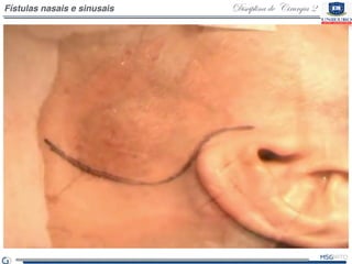 Disciplina de Cirurgia 2Fístulas nasais e sinusais
 