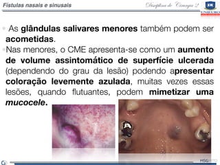 Disciplina de Cirurgia 2Fístulas nasais e sinusais
• As glândulas salivares menores também podem ser
acometidas.
•Nas meno...