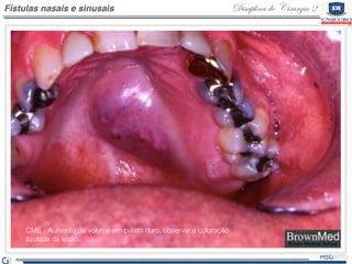 Disciplina de Cirurgia 2Fístulas nasais e sinusais
CME - Aumento de volume em palato duro, observar a coloração
azulada da...