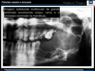 Disciplina de Cirurgia 2Fístulas nasais e sinusais
Imagem radiolúcida multilocular de grande
extensão envolvendo corpo, ra...