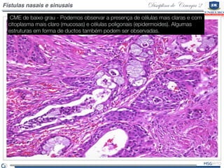 Disciplina de Cirurgia 2Fístulas nasais e sinusais
 CME de baixo grau - Podemos observar a presença de células mais claras e com
citoplasma mais claro (mucosas) e células poligonais (epidermoides). Algumas
estruturas em forma de ductos também podem ser observadas.
 