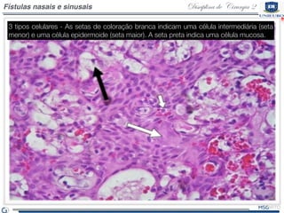 Disciplina de Cirurgia 2Fístulas nasais e sinusais
3 tipos celulares - As setas de coloração branca indicam uma célula intermediária (seta
menor) e uma célula epidermoide (seta maior). A seta preta indica uma célula mucosa.
 