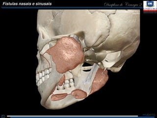 Disciplina de Cirurgia 2Fístulas nasais e sinusais
 