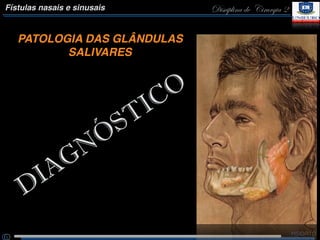 Disciplina de Cirurgia 2Fístulas nasais e sinusais
PATOLOGIA DAS GLÂNDULAS
SALIVARES
DIAGNÓSTICO
 