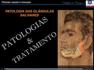 Disciplina de Cirurgia 2Fístulas nasais e sinusais
PATOLOGIA DAS GLÂNDULAS
SALIVARES
PATOLOGIAS
&
TRATAM
ENTO
 