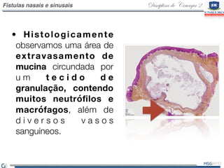 Disciplina de Cirurgia 2Fístulas nasais e sinusais
•  Histologicamente
observamos uma área de
extravasamento de
mucina cir...