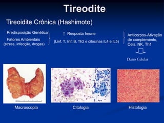 Tireodite
Tireoidite Crônica (Hashimoto)
Predisposição Genética
Fatores Ambientais
(stress, infecção, drogas)

↑ Resposta Imune
(Linf. T, linf. B, Th2 e citocinas IL4 e IL5)

Anticorpos-Ativação
de complemento,
Cels. NK, Th1

Dano Celular

Macroscopia

Citologia

Histologia

 