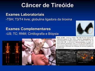 Câncer de Tireóide
Exames Laboratoriais
-TSH; T3/T4 livre; globulina ligadora da tiroxina

Exames Complementares
-US; TC; RNM; Cintilografia e Biópsia

 