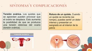 ¿Qué aspecto tiene un ovario
poliquístico?
En el síndrome del ovario
poliquístico, se pueden formar
quistes en los ovarios...